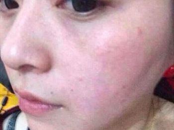 激素性皮炎反复发作是什么原因  激素脸 美白祛黄 第3张