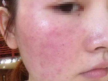 激素脸排毒时脸会烂吗  激素脸 美白祛黄 第2张