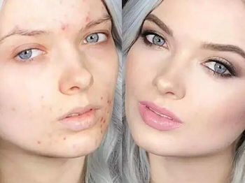 激素脸排毒时脸会烂吗  激素脸 美白祛黄 第3张