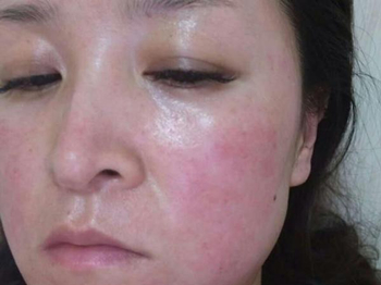 激素脸排毒为什么会肿，有时候还会发红  激素脸 美白祛黄 第2张