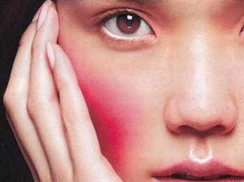 激素脸排毒为什么会肿，有时候还会发红  激素脸 美白祛黄 第3张