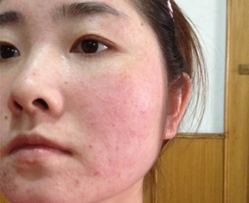 激素脸喝酵素脸过敏吗