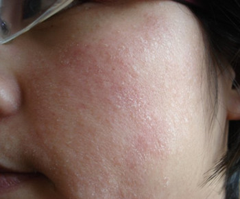 爱宁达治疗激素脸管用吗，有激素么