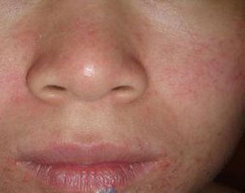 一到冬天脸就过敏疼怎么办