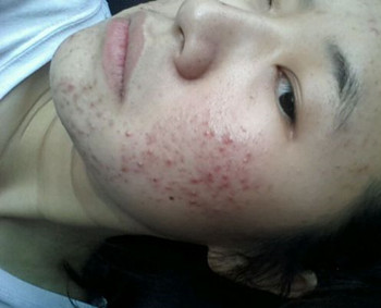 马齿苋对激素脸管用吗