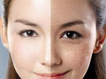 激素脸色素沉着怎么办