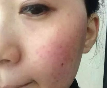 激素脸色素沉着怎么办  激素脸 怎么办 美白祛黄 第2张