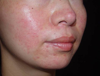 激素脸用清毒丸可以吗