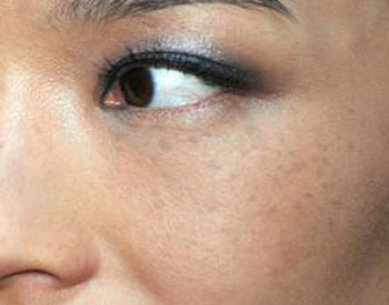 怎样知道脸上有激素、铅汞  激素 铅汞 美白祛黄 第3张