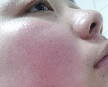激素脸为什么会痒，止痒方法有什么