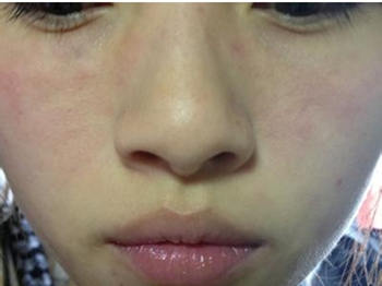 脸过敏了不吃药能自愈吗