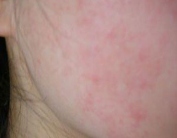 脸上反复过敏怎么回事，怎么办