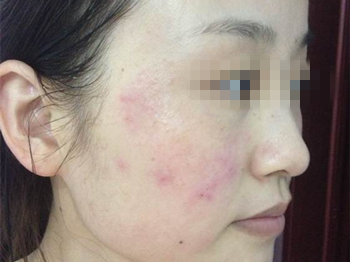 脸上用了含激素的产品应该怎么办  激素脸 美白祛黄 第2张