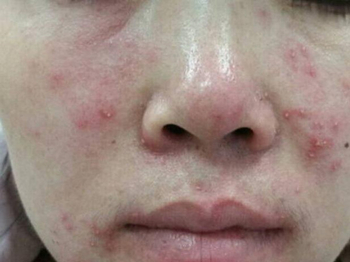 脸上用了含激素的产品应该怎么办  激素脸 美白祛黄 第3张