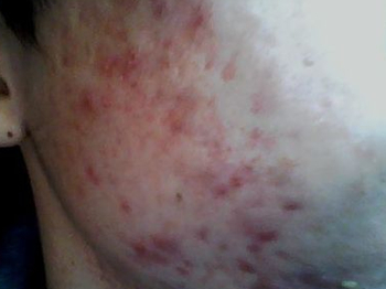 脸上用了含激素的产品应该怎么办  激素脸 美白祛黄 第4张