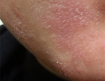 激素脸脱皮是排毒吗