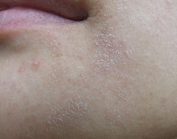 激素脸脱皮是排毒吗  激素脸 美白祛黄 第2张