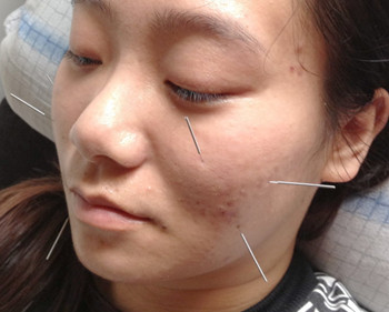 放血对激素脸的效果怎么样