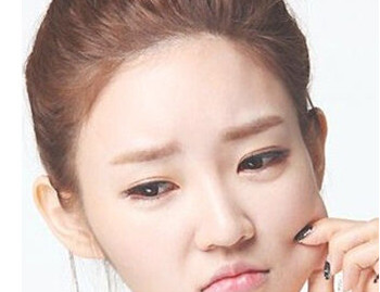 轻度激素脸怎么治，多久能恢复  轻度 激素脸 美白祛黄 第2张