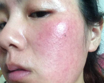 激素脸恢复中怎样保养