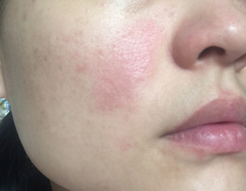 激素脸恢复中怎样保养  激素脸 美白祛黄 第2张