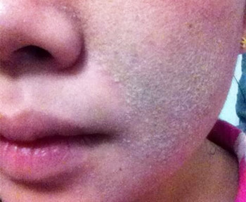 得了激素脸怎么补救