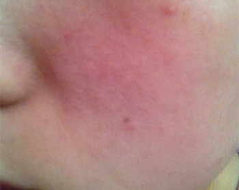 摩登季修复激素脸可信吗，过程是什么