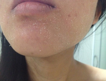 脸上过敏脱皮了怎么办