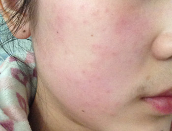 激素脸和过敏脸的区别是什么