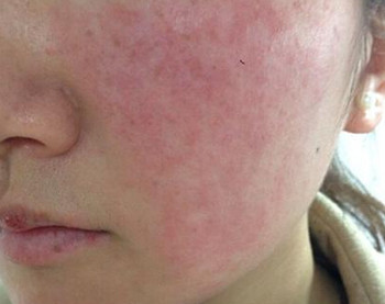 激素脸和过敏脸的区别是什么  激素脸 过敏 美白祛黄 第2张