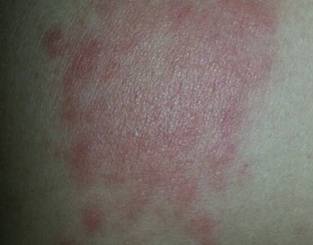 吃螃蟹脸上过敏怎么办  螃蟹 过敏 怎么办 美白祛黄 第2张