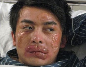 吃螃蟹脸上过敏怎么办  螃蟹 过敏 怎么办 美白祛黄 第4张