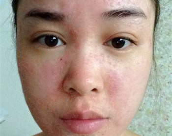 怎么测试激素脸