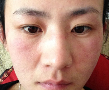 怎么测试激素脸  激素脸 美白祛黄 第2张