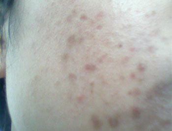 脸上过敏留下的黑印怎么办