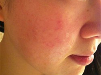 脸上过敏怎么回事