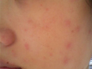 脸部化妆品过敏怎么办急救小方法