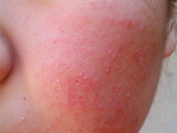 脸部化妆品过敏怎么办急救小方法  脸部 化妆品 怎么办 美白祛黄 第3张