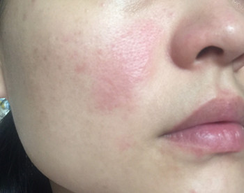 激素脸会传染吗