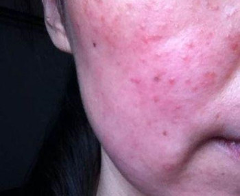 激素脸会传染吗  激素脸 美白祛黄 第2张