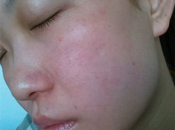 激素脸排毒症状、排毒方法是什么