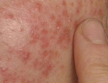 脸上皮肤老过敏是什么原因