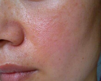 激素脸的红怎么退  激素脸 美白祛黄 第2张