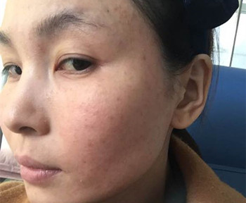 激素脸的危害你知道有哪些吗  激素脸 美白祛黄 第2张