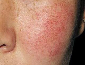 脸上的红血丝越来越明显是为什么