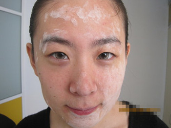 激素脸用什么洗脸最好