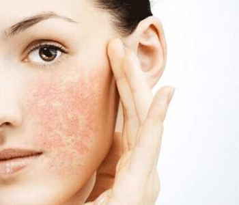 用化妆品脸过敏肿了怎么消除