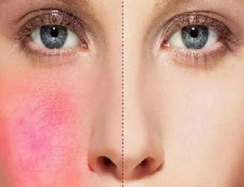 面部毛细血管扩张是什么原因怎么治疗