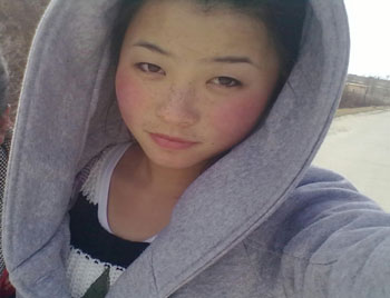 冬天脸冻了发红怎么恢复