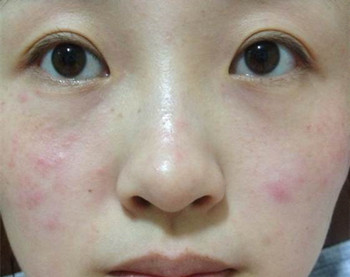 激素脸反复发作怎么办